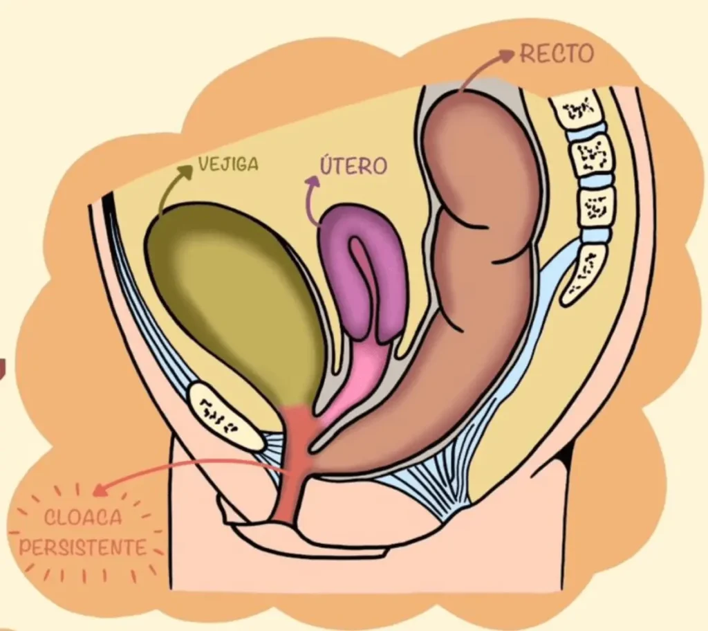 Dibujo indicando anatomía de la malformación anorrectal. Se observa la confluencia de ano, vagina y uretra en conducto común