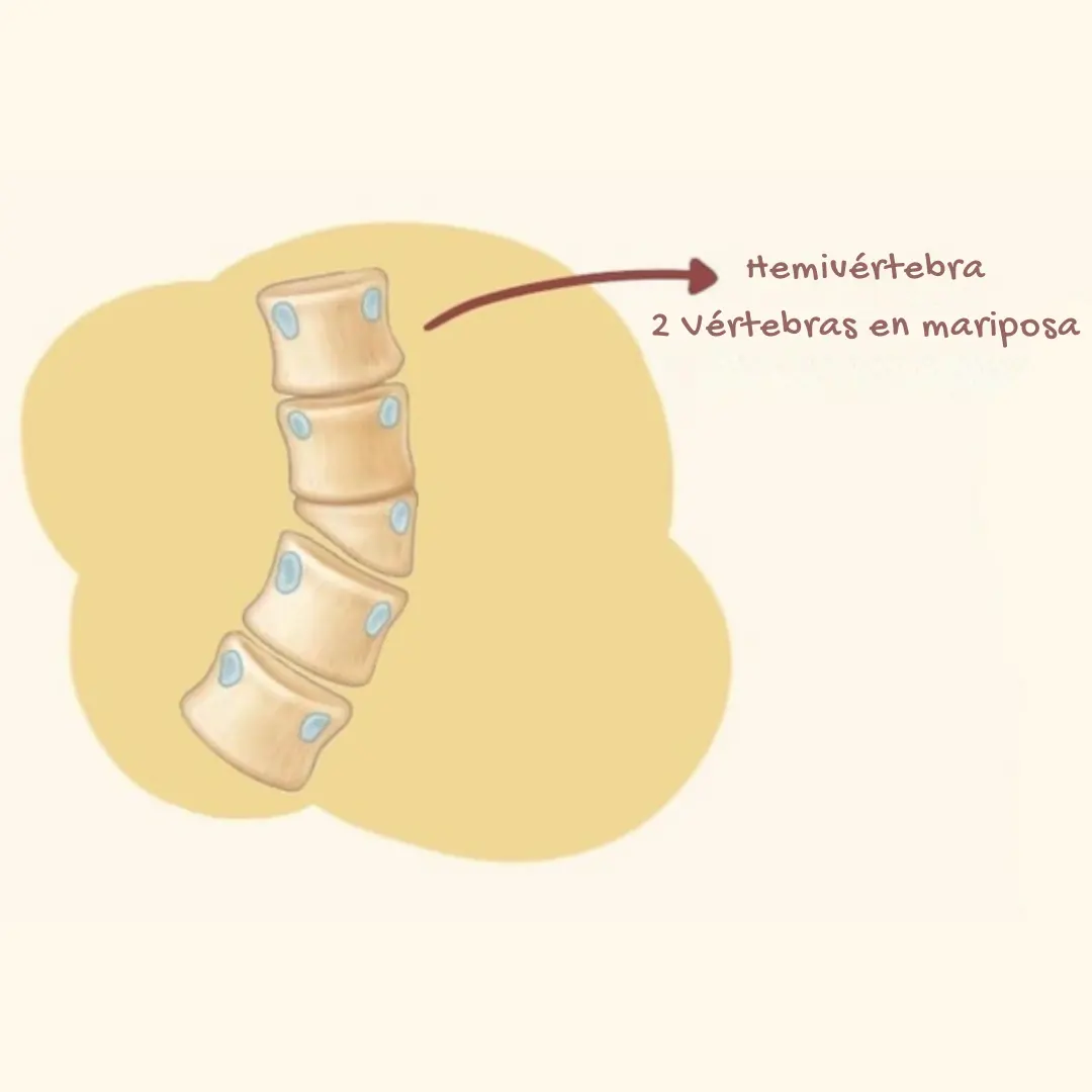 Asociación VACTERL 1 En el dibujo se ve la columna vertebral y una flecha indicando la enfermedad "Hemivértebra"