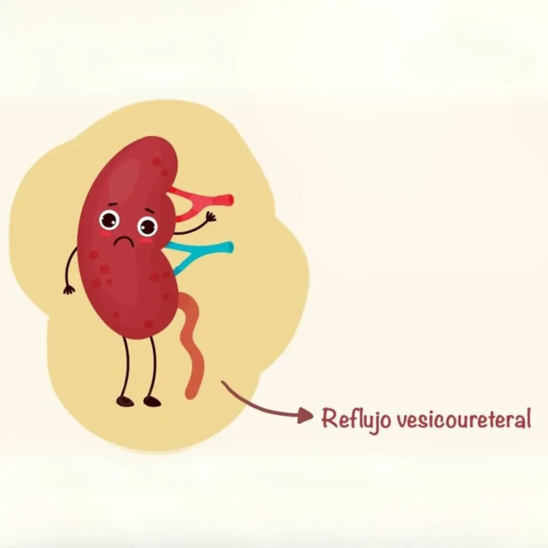 Asociación VACTERL 4 Es un dibujo del riñón con unos ojos, manos y pies. Además esta dibujada una flecha indicando reflujo vesicoureteral